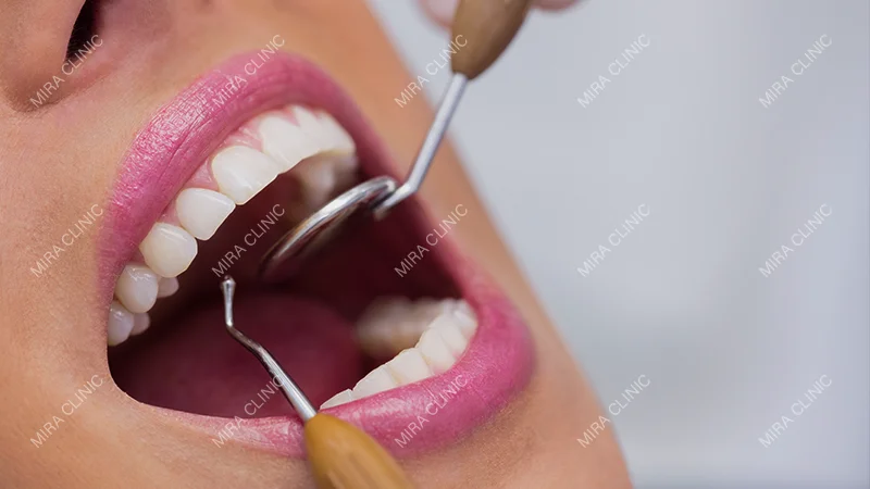 final veneers adjustments